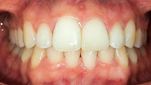 Después del tratamiento Invisalign: alineación estética y funcional lograda